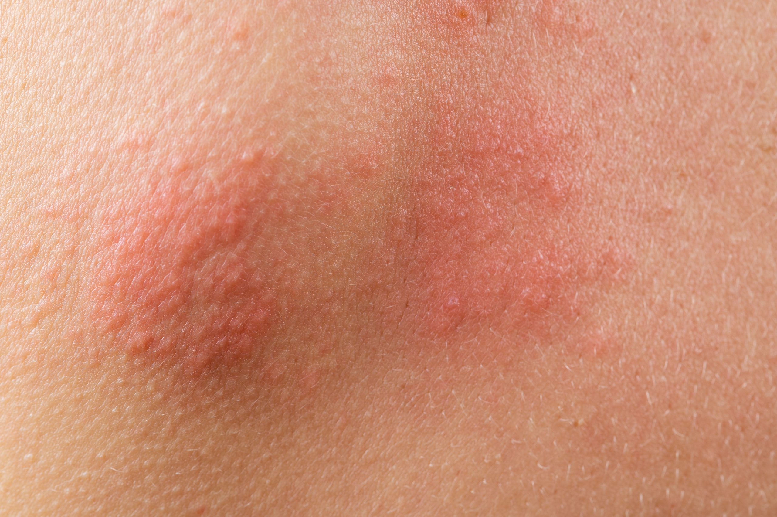 Shingles-treatment